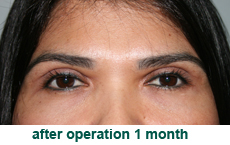 plastic_surgery_eyelid_upper_98.52.